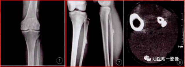 软骨类肿瘤主要内容回顾-16