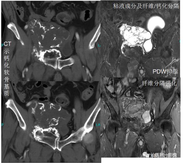 软骨类肿瘤主要内容回顾-26