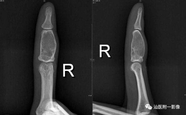 软骨类肿瘤主要内容回顾-9