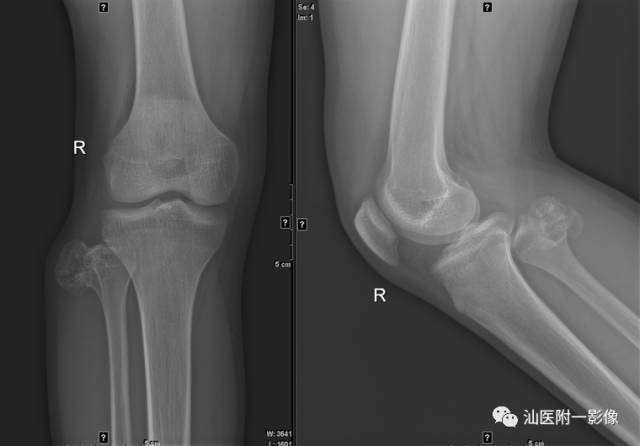 软骨类肿瘤主要内容回顾-5
