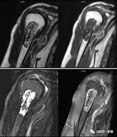软骨类肿瘤主要内容回顾-11