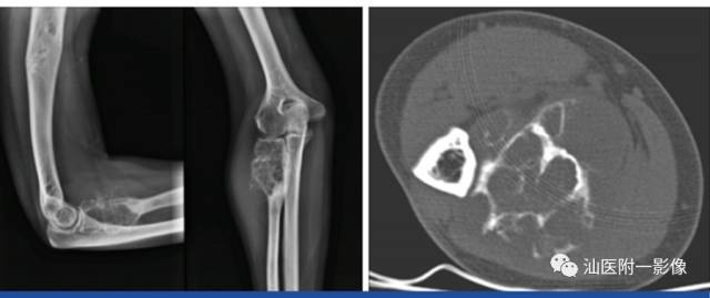 软骨类肿瘤主要内容回顾-23