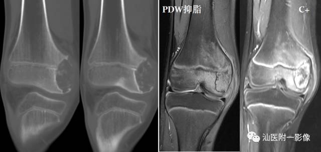 软骨类肿瘤主要内容回顾-21