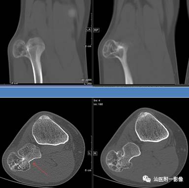 软骨类肿瘤主要内容回顾-6
