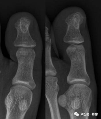 软骨类肿瘤主要内容回顾-14