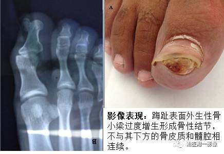 软骨类肿瘤主要内容回顾-13