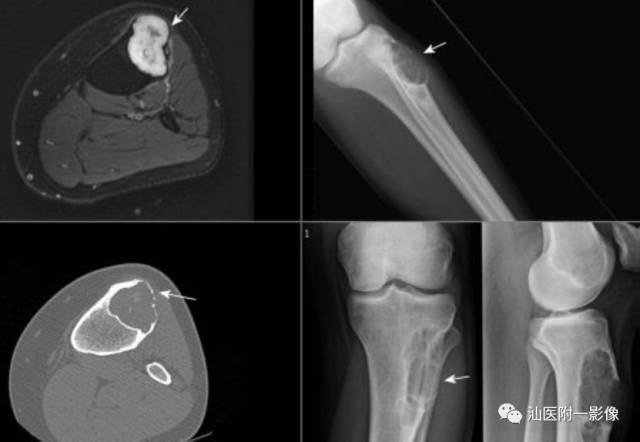 软骨类肿瘤主要内容回顾-22