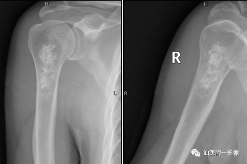 软骨类肿瘤主要内容回顾-10