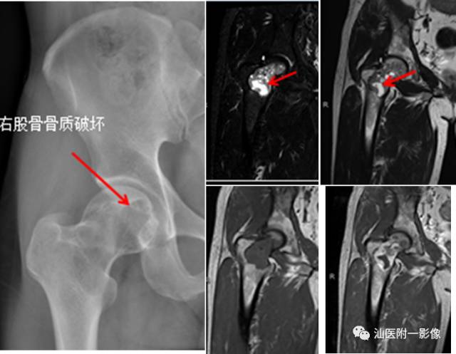 软骨类肿瘤主要内容回顾-19