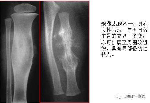软骨类肿瘤主要内容回顾-12