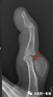 软骨类肿瘤主要内容回顾-7