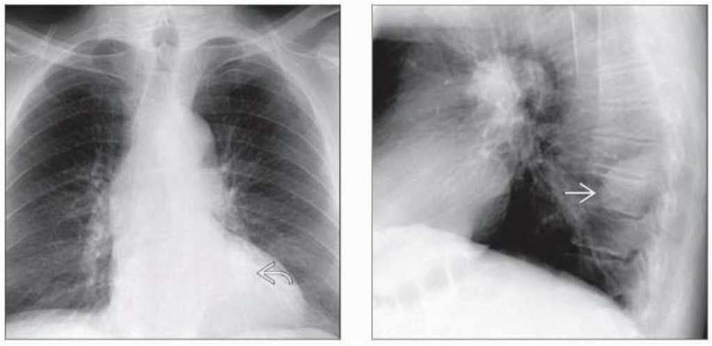 神经源性肿瘤(神经鞘膜来源)影像表现-3 神经源性肿瘤(神经鞘膜来源)影像表现-3