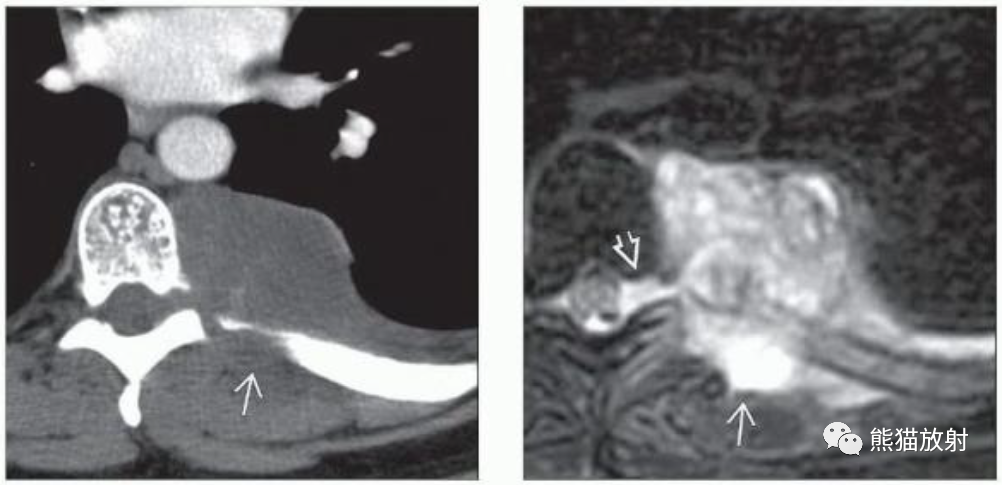 神经源性肿瘤(神经鞘膜来源)影像表现-5 神经源性肿瘤(神经鞘膜来源)影像表现-5