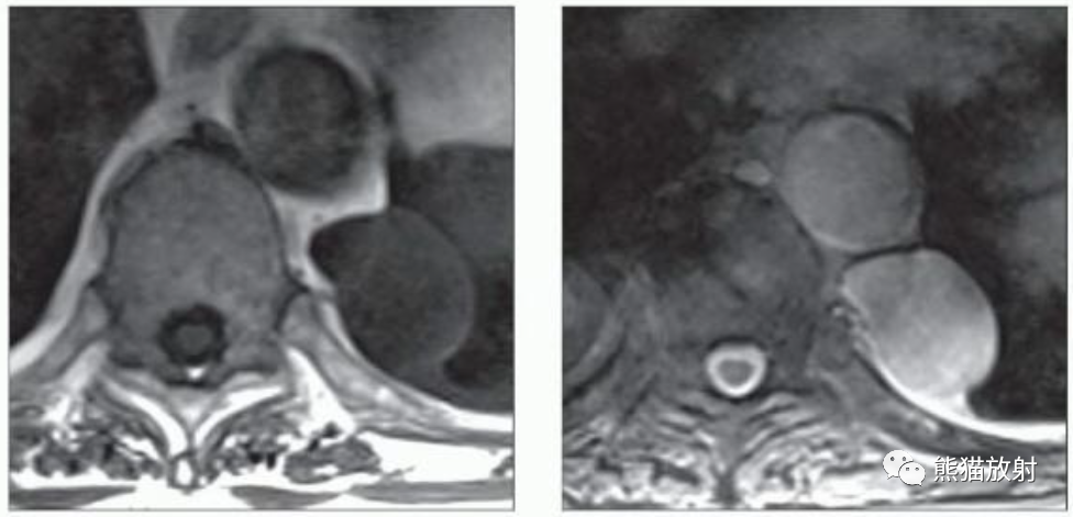 神经源性肿瘤（神经鞘膜来源）影像表现-4