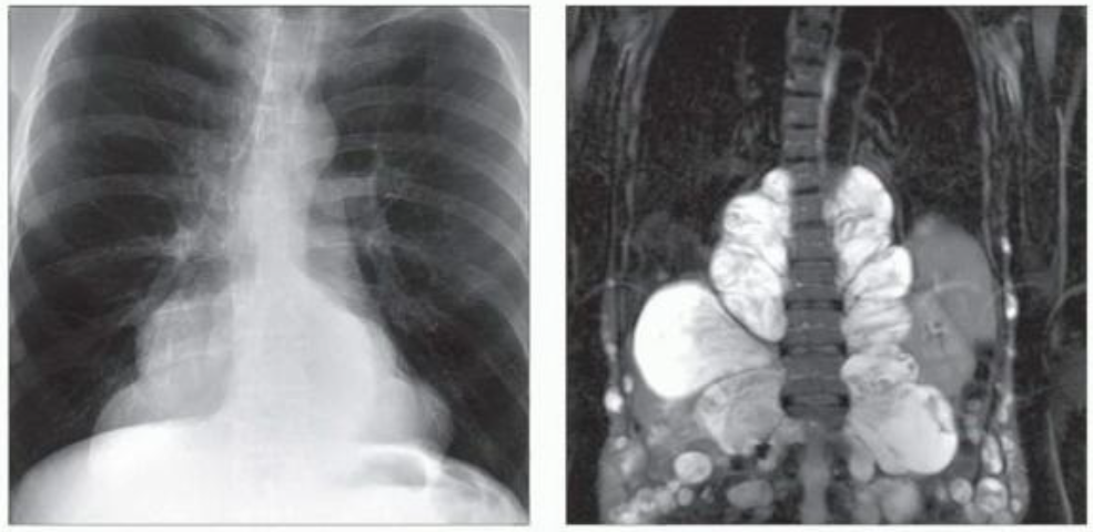 神经源性肿瘤(神经鞘膜来源)影像表现-2 神经源性肿瘤(神经鞘膜来源)影像表现-2