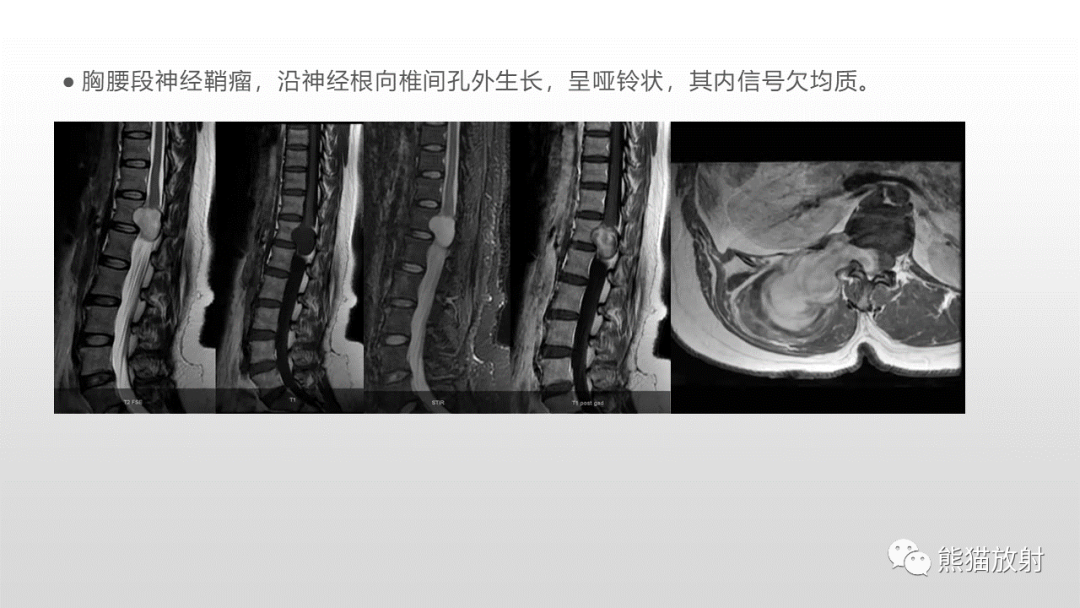 【病例】脊膜瘤2例MR影像-32