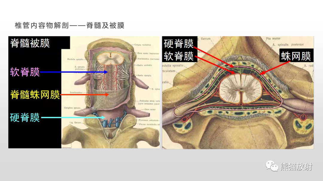 【病例】脊膜瘤2例MR影像-12