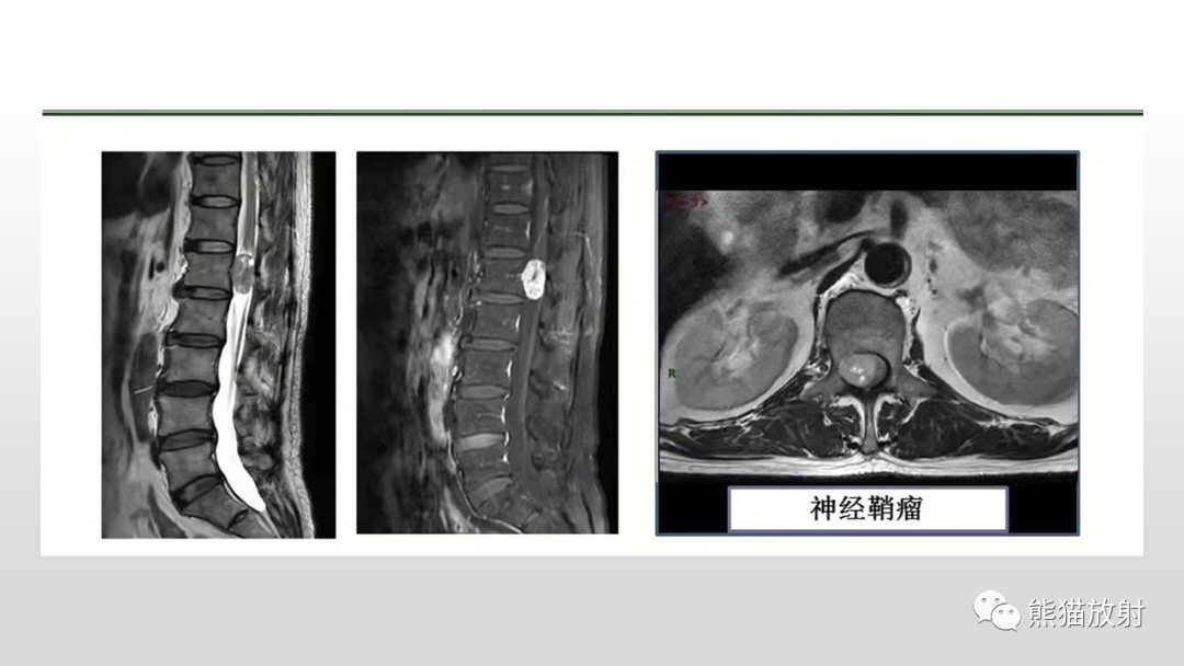 【病例】脊膜瘤2例MR影像-30