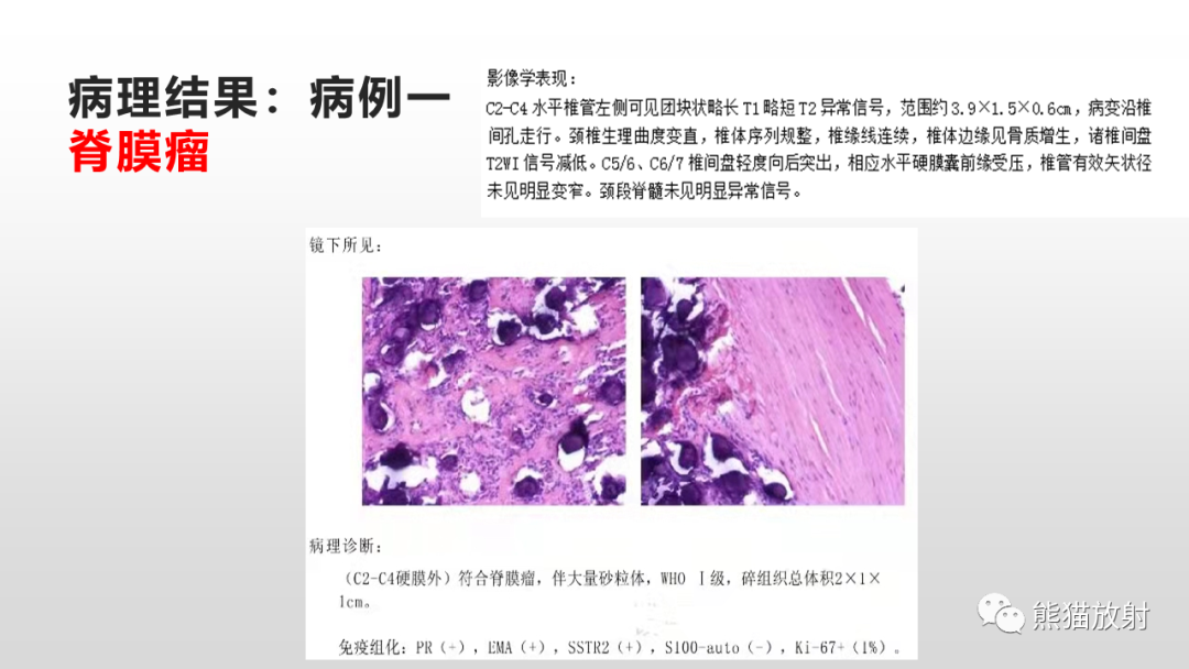 【病例】脊膜瘤2例MR影像-8