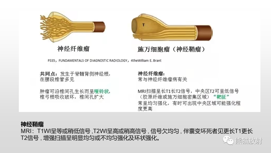 【病例】脊膜瘤2例MR影像-29