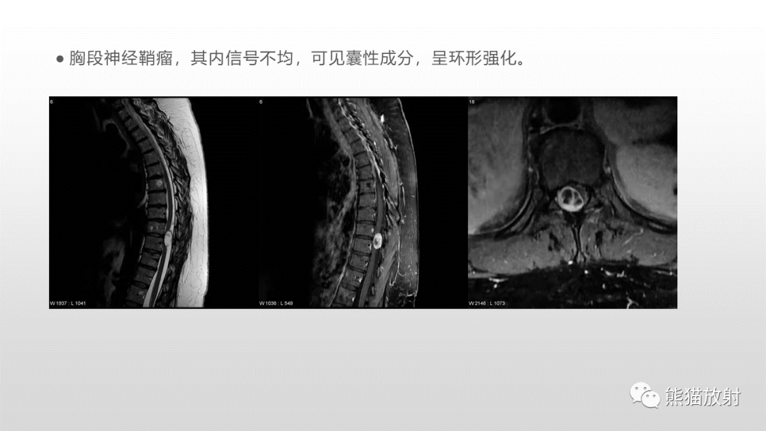 【病例】脊膜瘤2例MR影像-33