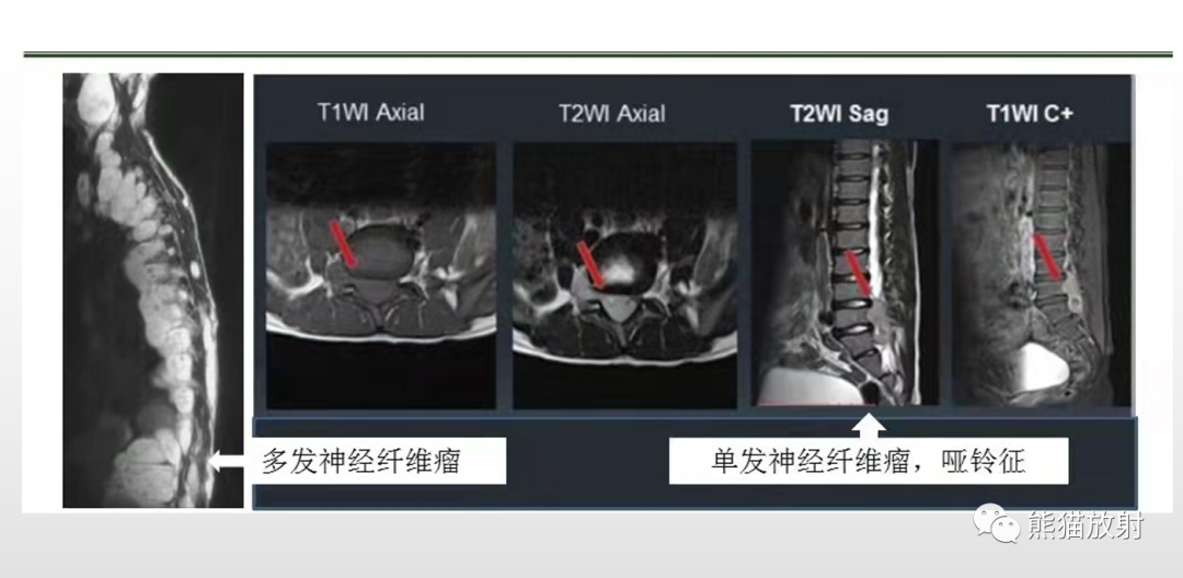 【病例】脊膜瘤2例MR影像-31
