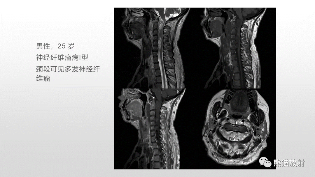 【病例】脊膜瘤2例MR影像-35