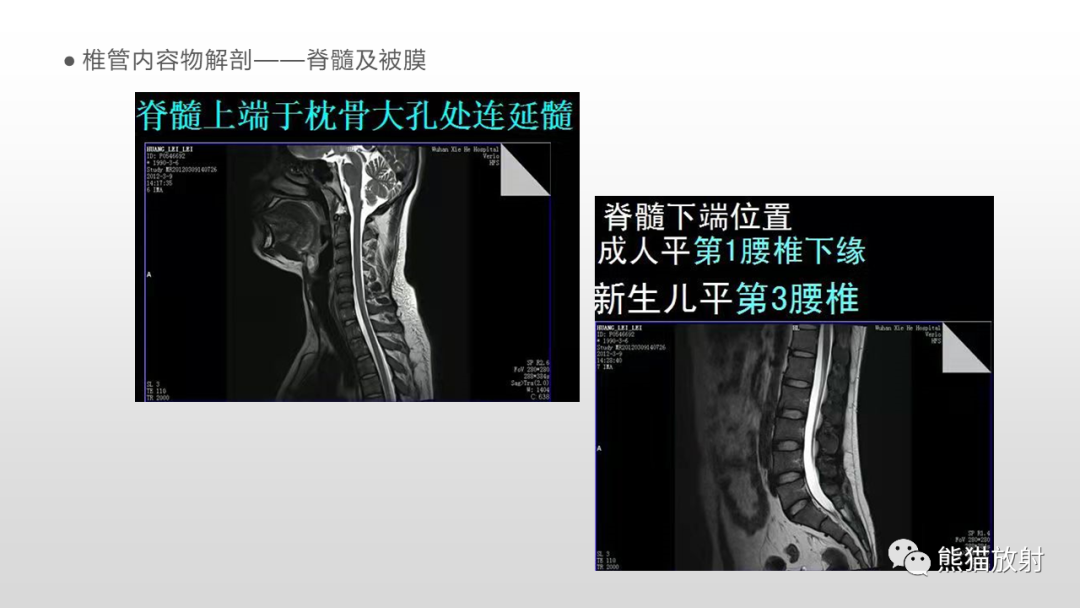 【病例】脊膜瘤2例MR影像-11