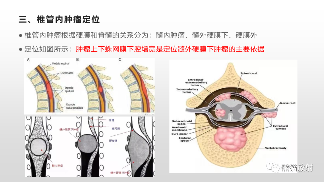 【病例】脊膜瘤2例MR影像-20