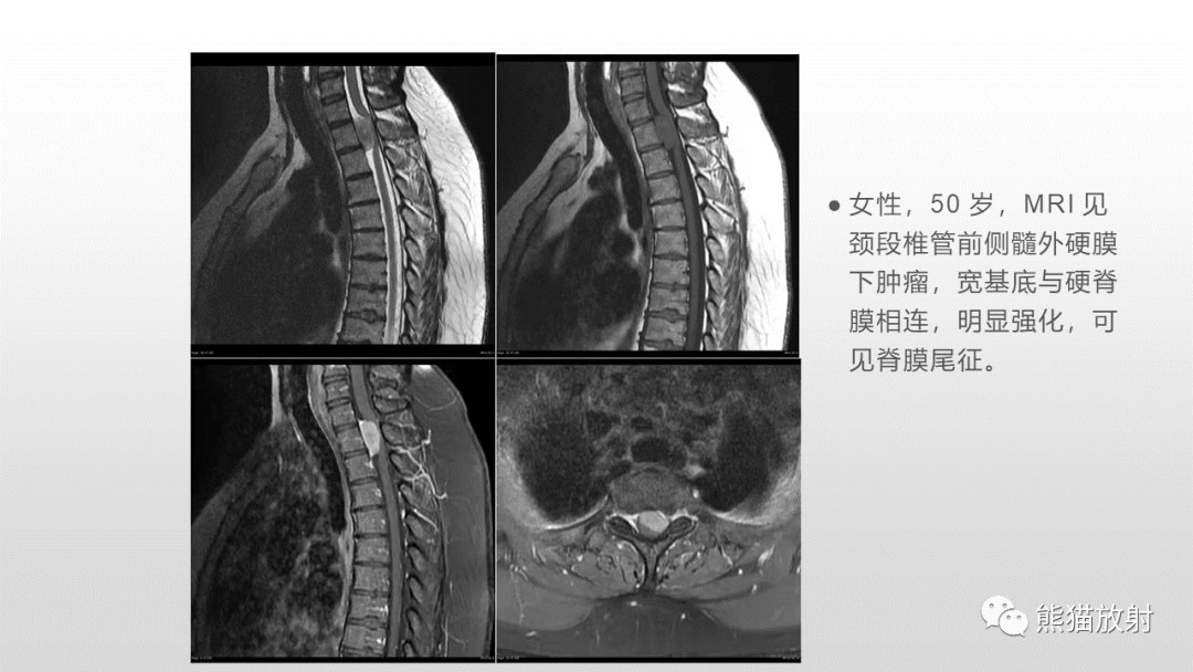 【病例】脊膜瘤2例MR影像-26