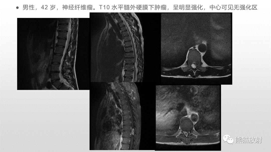 【病例】脊膜瘤2例MR影像-1