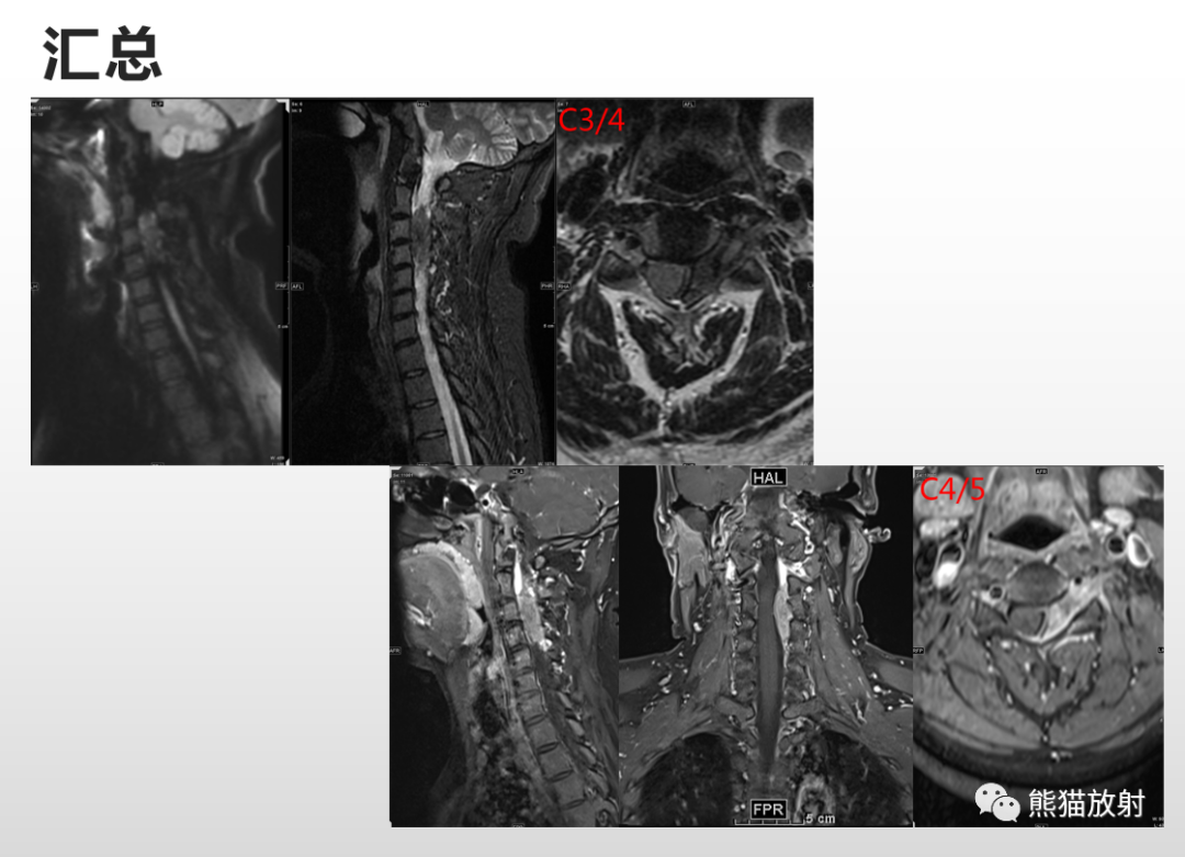 【病例】脊膜瘤2例MR影像-3
