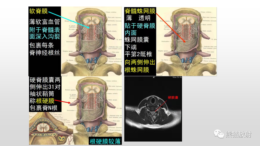 【病例】脊膜瘤2例MR影像-13