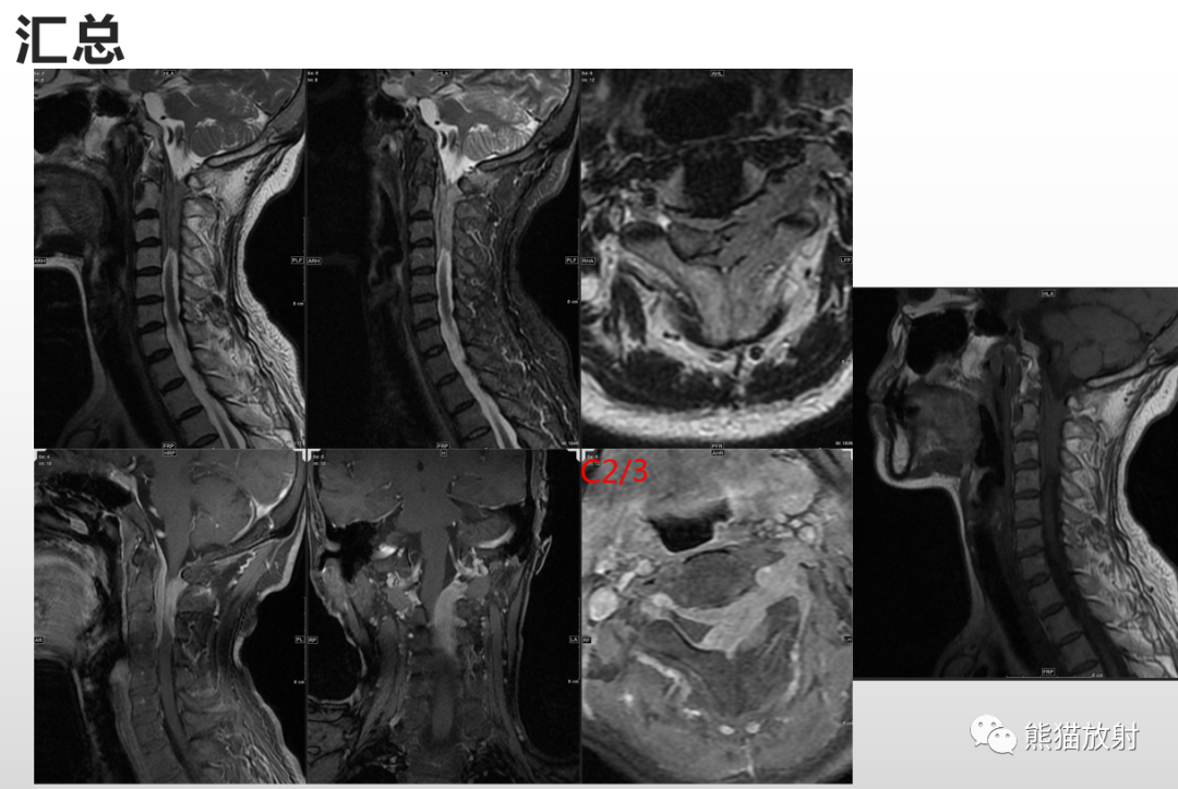 【病例】脊膜瘤2例MR影像-6