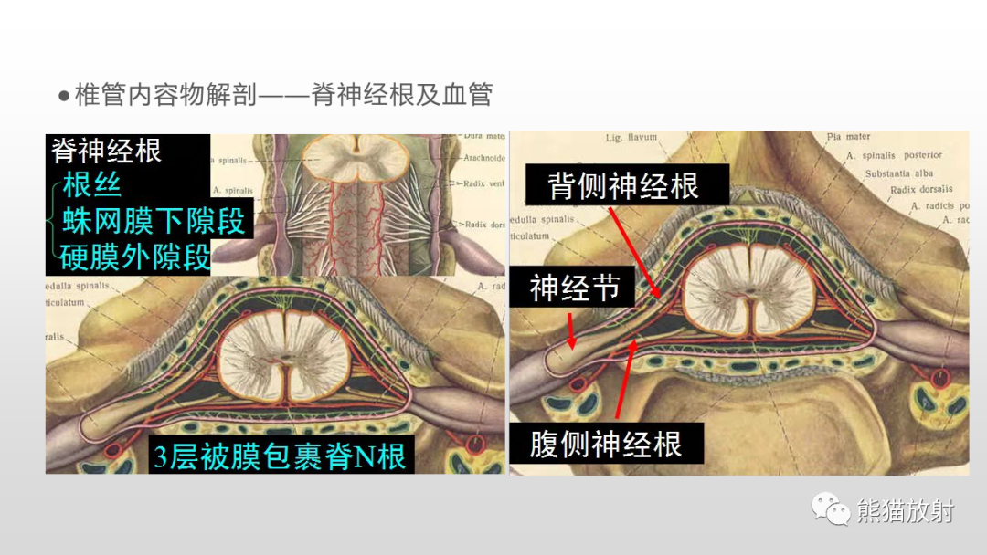 【病例】脊膜瘤2例MR影像-17