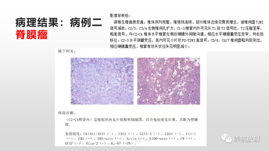 【病例】脊膜瘤2例MR影像-9