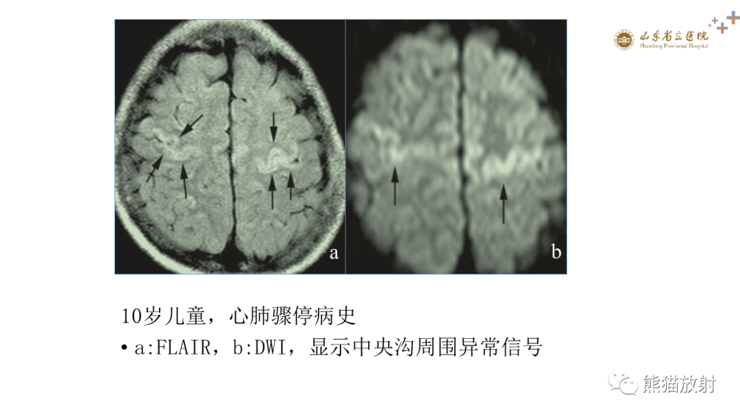 【PPT】成人缺氧缺血性脑病影像学表现-21