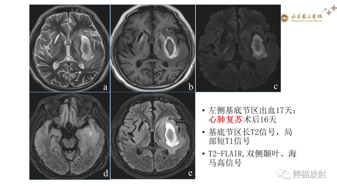 【PPT】成人缺氧缺血性脑病影像学表现-18