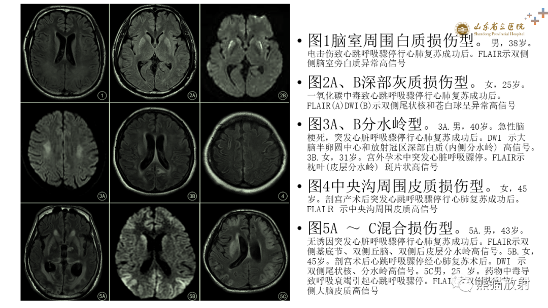 【PPT】成人缺氧缺血性脑病影像学表现-24