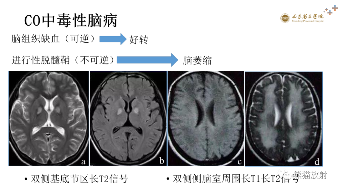 【PPT】成人缺氧缺血性脑病影像学表现-30