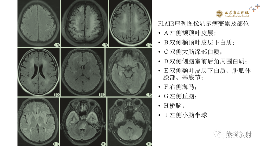【PPT】成人缺氧缺血性脑病影像学表现-23