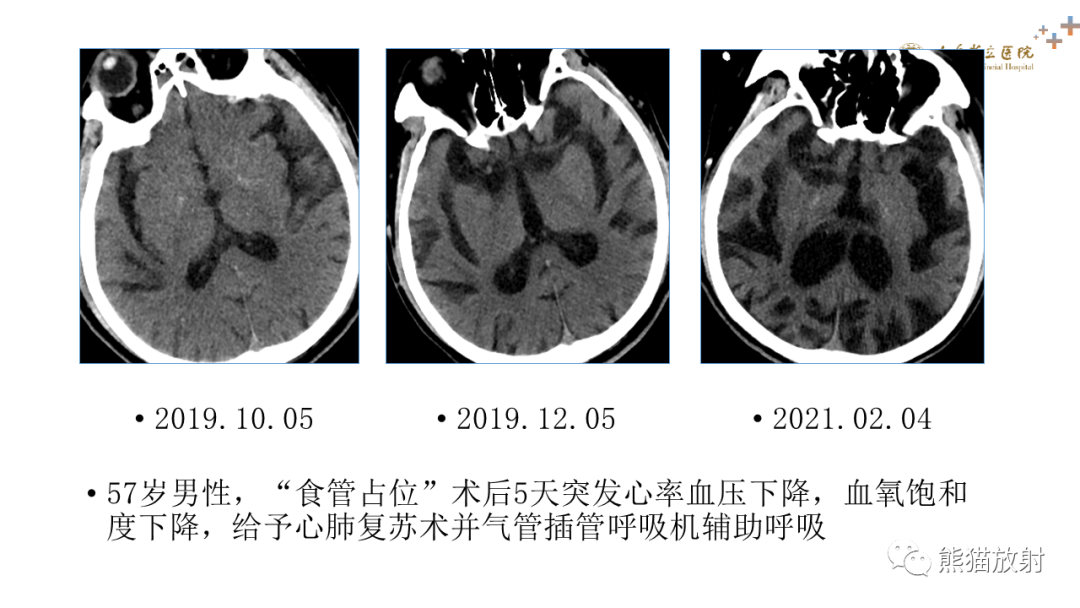 【PPT】成人缺氧缺血性脑病影像学表现-13