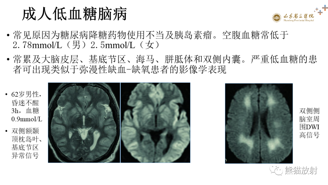 【PPT】成人缺氧缺血性脑病影像学表现-27