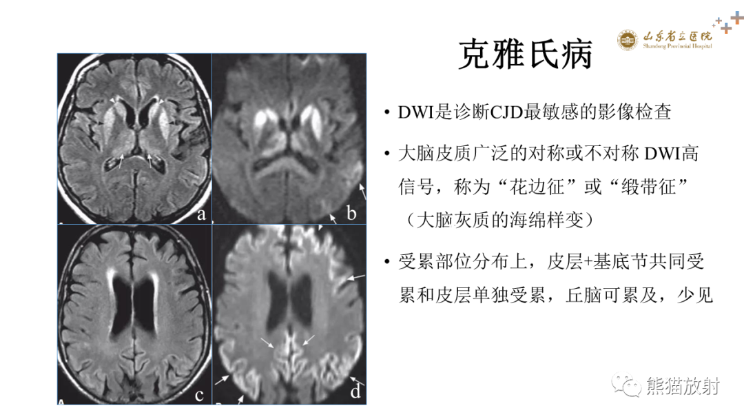 【PPT】成人缺氧缺血性脑病影像学表现-32