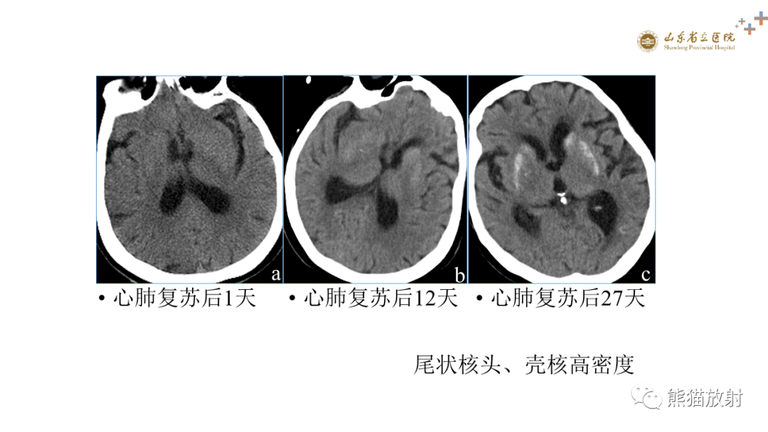 【PPT】成人缺氧缺血性脑病影像学表现-35