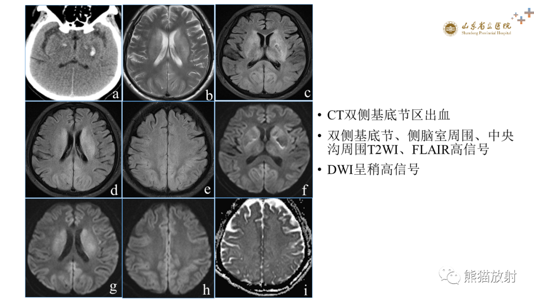 【PPT】成人缺氧缺血性脑病影像学表现-20