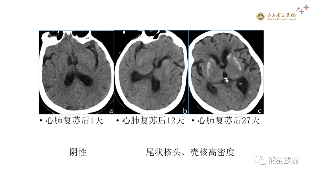 【PPT】成人缺氧缺血性脑病影像学表现-11