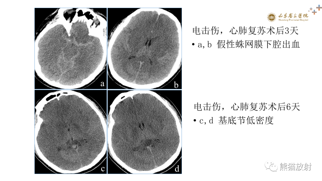 【PPT】成人缺氧缺血性脑病影像学表现-12