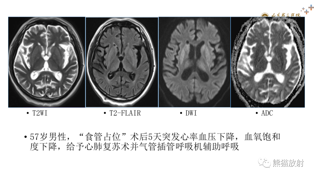 【PPT】成人缺氧缺血性脑病影像学表现-17
