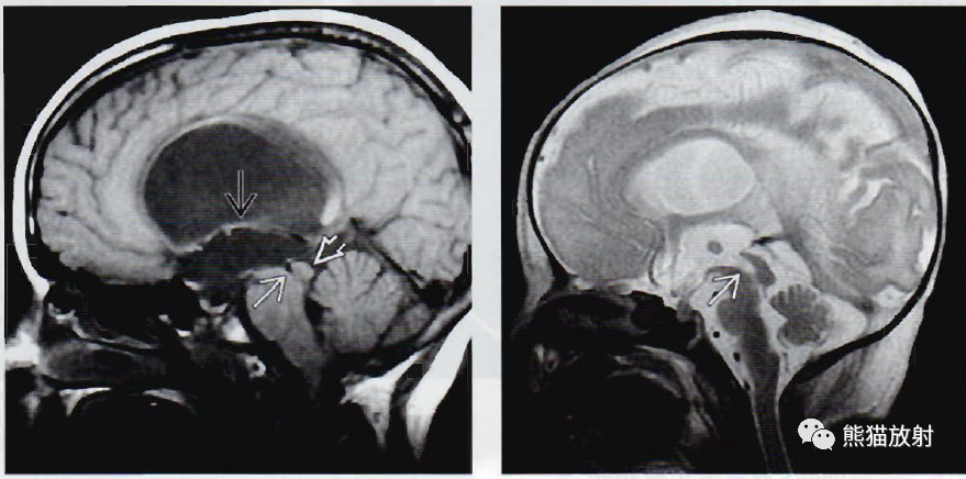 ​中脑导水管狭窄影像诊断要点-2
